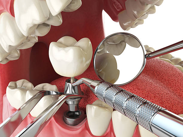 Best Emergency Tooth Extraction in Moroni, UT